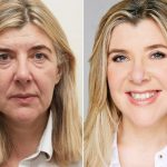 Factors That Impact the Average Facelift Cost